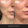 Mighty Patch™ Invisible+ Patch - Daytime Hydrocolloid Acne Pimple Patches for Covering Zits and Blemishes, Ultra Thin Spot Stickers for Face and Skin (24 Medium and 15 Small Patches)