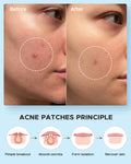 Litbear Acne Pimple Patches- Day and Night 4 Sizes 180 Dots Thin & Thick Hydrocolloid Patches with Witch Hazel, Tea Tree & Calendula Oil, Extra
