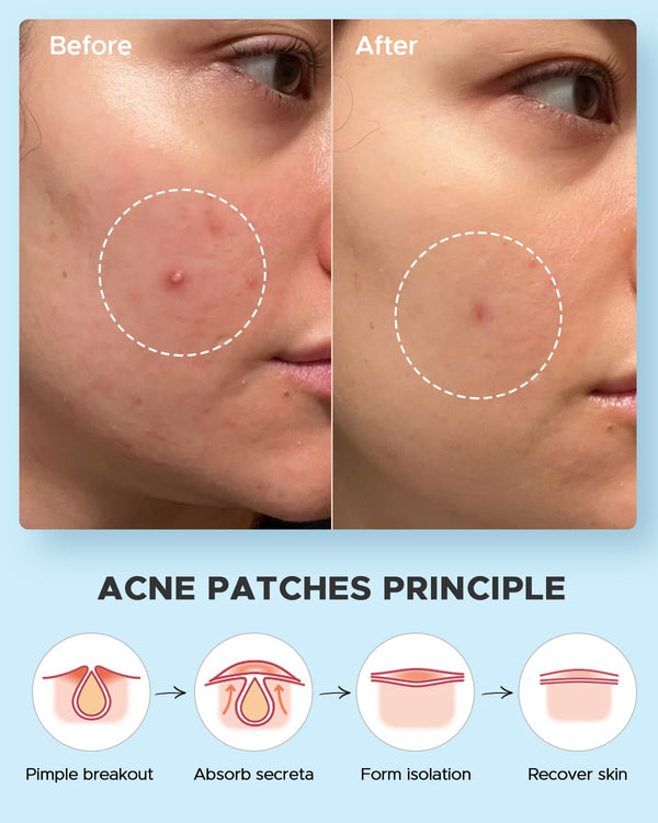Litbear Acne Pimple Patches- Day and Night 4 Sizes 180 Dots Thin & Thick Hydrocolloid Patches with Witch Hazel, Tea Tree & Calendula Oil, Extra