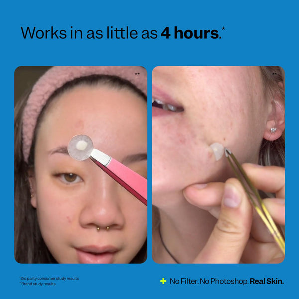 Peach Slices | Acne Spot Dots | Hydrocolloid Acne Patches | for Zits, Blemishes, & Breakouts | Vegan | Cruelty-Free | Pimple Patches | Facial Skin