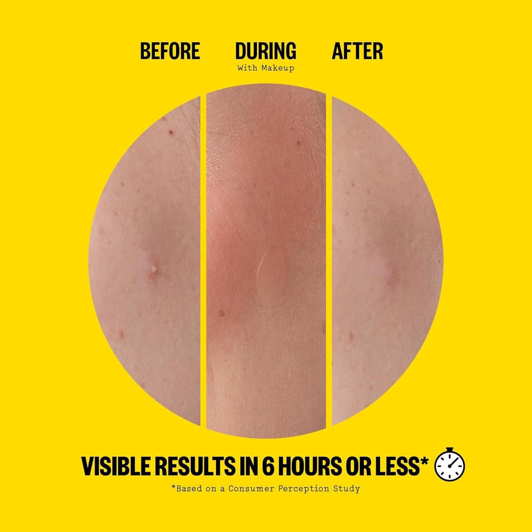 PEACE OUT Acne Day Dot, Sheer Acne Healing Dots, Virtually Invisible Wear, Hydrocolloid Pimple Patches Helps Clear Blemishes Quickly with Encapsulated Salicylic Acid, Retinol & Aloe Vera, 20 Dots