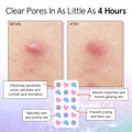 grace & stella Award Winning Pore Strip - Pimple Patches for Face - Hydrocolloid Acne Patches - Absorbs Zits, Reduces Redness - Cute Patches