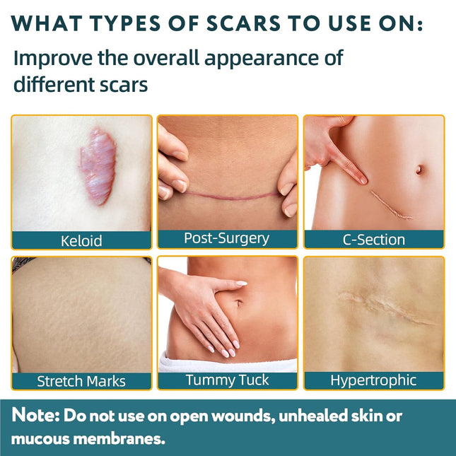 Silicone Scar Sheets, Silicone Scar Tape for Surgical Scars - 60" X 1.6" Roll - 