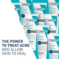 Cerave Acne Foaming Cream Cleanser, 4% Benzoyl Peroxide Face Wash with Hyaluronic Acid, Niacinamide & Ceramides, Gentle Daily Acne Treatment for Face