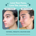 Proactiv 3 Step Acne Treatment - Benzoyl Peroxide Face Wash, Repairing Acne Spot Treatment for Face and Body, Exfoliating Toner - 30 Day Complete