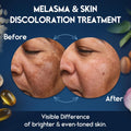 Melasma Treatment for Face - Melasma Cream & Age Spot Remover for Skin Discoloration, Post-Blemish Marks, Scars & Spots | Dark Spot Remover for