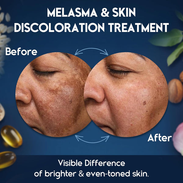 Melasma Treatment for Face - Melasma Cream & Age Spot Remover for Skin Discoloration, Post-Blemish Marks, Scars & Spots | Dark Spot Remover for