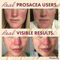 Prosacea - Medicated Rosacea Treatment for Face - Heals Rosacea Symptoms of Redness, Pimples and Irritation - Fragrance Free - 0.75 oz Pack of 1
