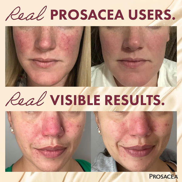 Prosacea - Medicated Rosacea Treatment for Face - Heals Rosacea Symptoms of Redness, Pimples and Irritation - Fragrance Free - 0.75 oz Pack of 1