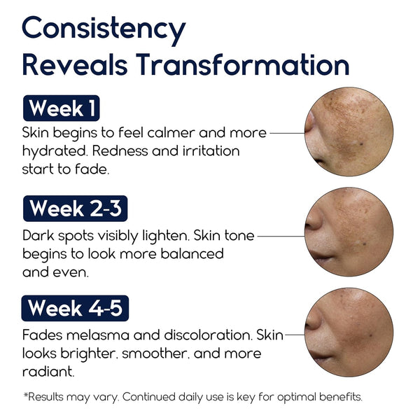 Melasma Treatment for Face - Melasma Cream & Age Spot Remover for Skin Discoloration, Post-Blemish Marks, Scars & Spots | Dark Spot Remover for