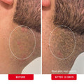 First Aid Beauty - Ingrown Hair Pads with BHA + AHA - Aftershave Treatment Pads to Help Prevent Razor Bumps for Men & Women - Exfoliate Underarms