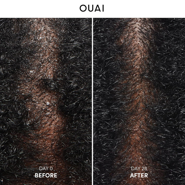 OUAI anti Dandruff Shampoo - Soothing Salicylic Acid Shampoo for Flaky, Dry and 