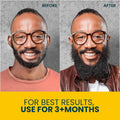 Beard Oil for Black Men with Sensitive Skin - Non Comedogenic Beard Oil - Safe for Acne Prone Skin - Unscented, Soothing, Natural, Lightweight and